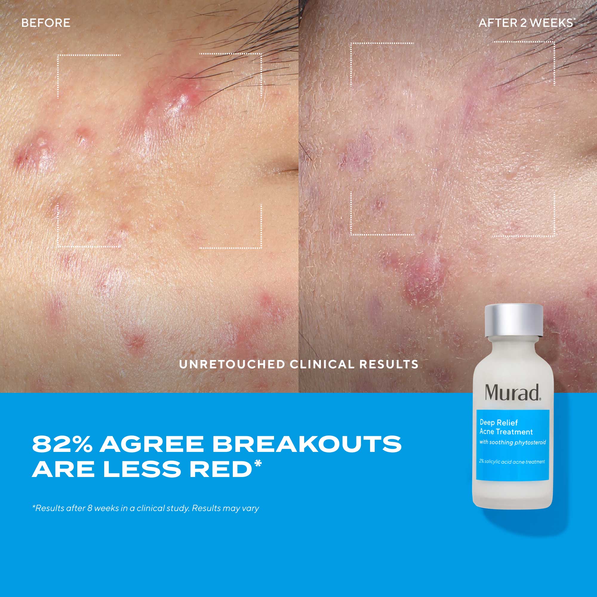 Deep Relief Acne Treatment - Image 4