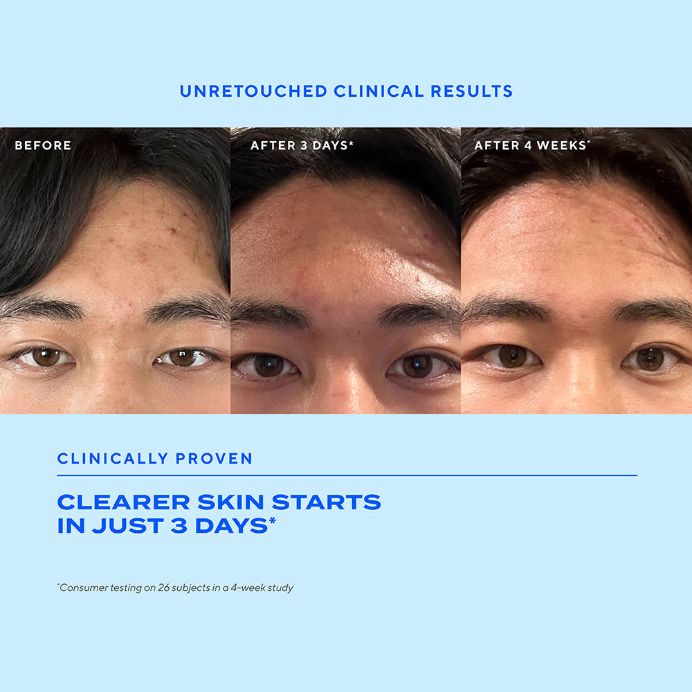 Biome-Balancing Clear & Prevent Acne Treatment Serum - Image 7