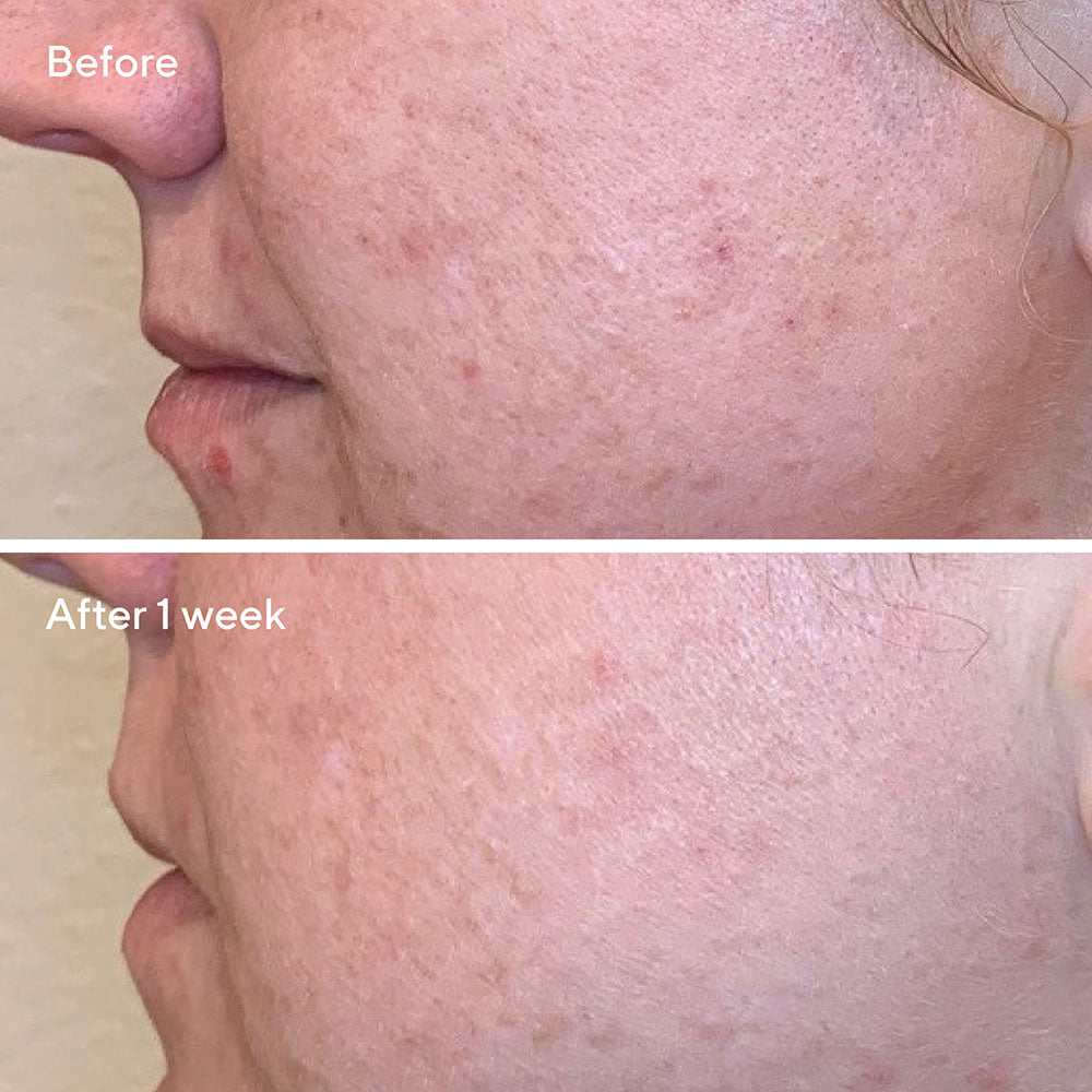 AHA/BHA/Retinoid Daily Clarifying Peel - Image 4